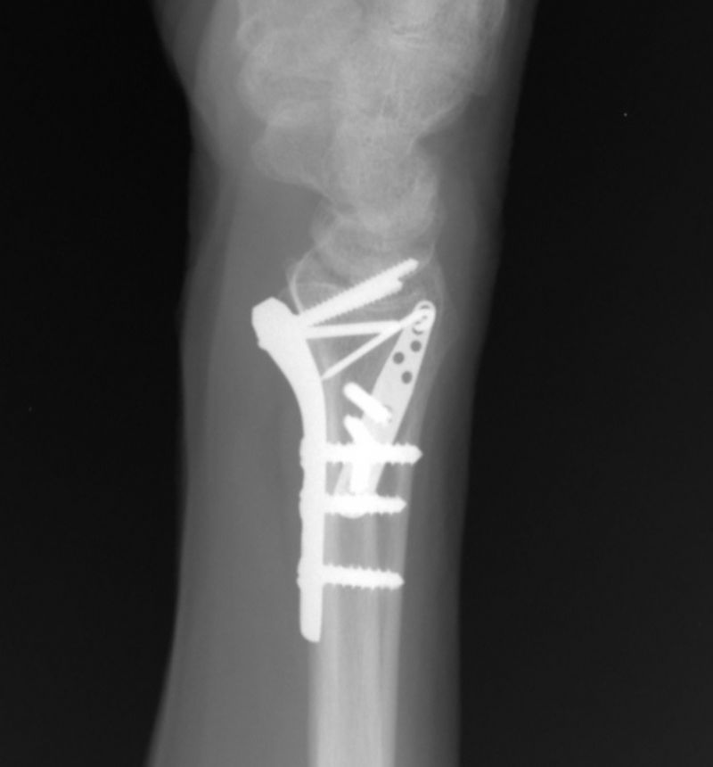 Radius, Distal:  Synthes Distal Radius Plate (Implant 4265)